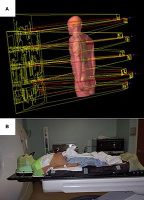 Volumetric modulated arc therapy based total marrow and lymphoid irradiation: Workflow and clinical experience